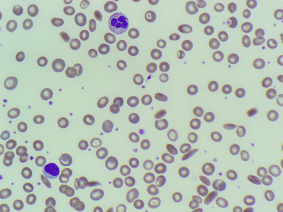 BloodScientist's tweet photo. #MorphologyMonday

"Hi," said the person on the phone. "Can you please take a look at the film for this patient urgently. And also do the screening test?"

"Sure thing. Give me 15 mins," I replied.

What do the blood film and the screening result show?

#OnlyCells #RedCells https://t.co/DajT8FxJKz