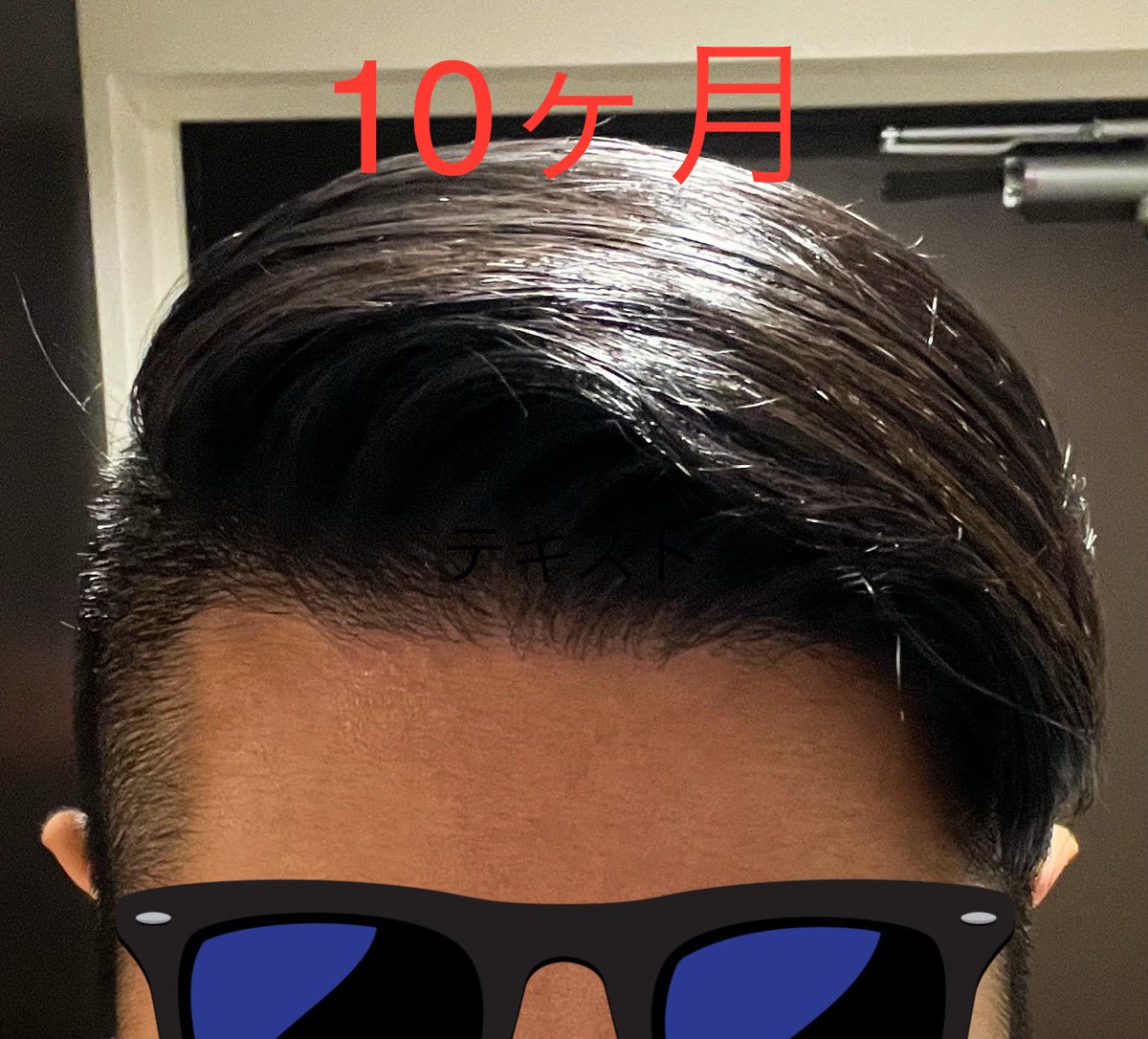 CEO_bodymaker's tweet photo. 【植毛から10ヶ月】
移植毛は順調に成長しています。
あまりに自然に馴染んでおり、良い意味で最近は髪のことを考える機会が減ってきました☀️

「薄くなってきたら2回目やりたいかも？」と思うことはありますが、まずは2ヶ月後の「1年経過の状況」を待ちたいと思います😊

@pagepagetan
@pasuoat
🙏✨ https://t.co/qTX5UuwcVR