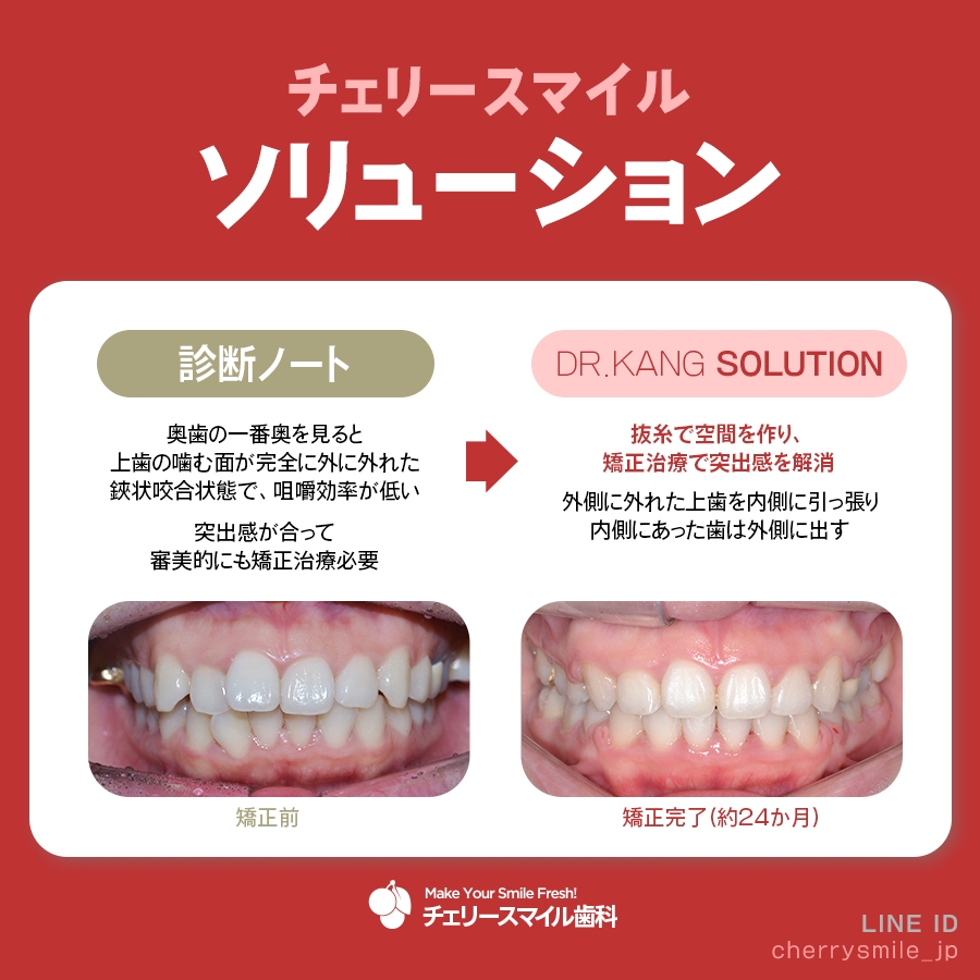 ♡裁断済 虫歯思いの歯科矯正治療 すきっ歯 - অনুসন্ধান / X