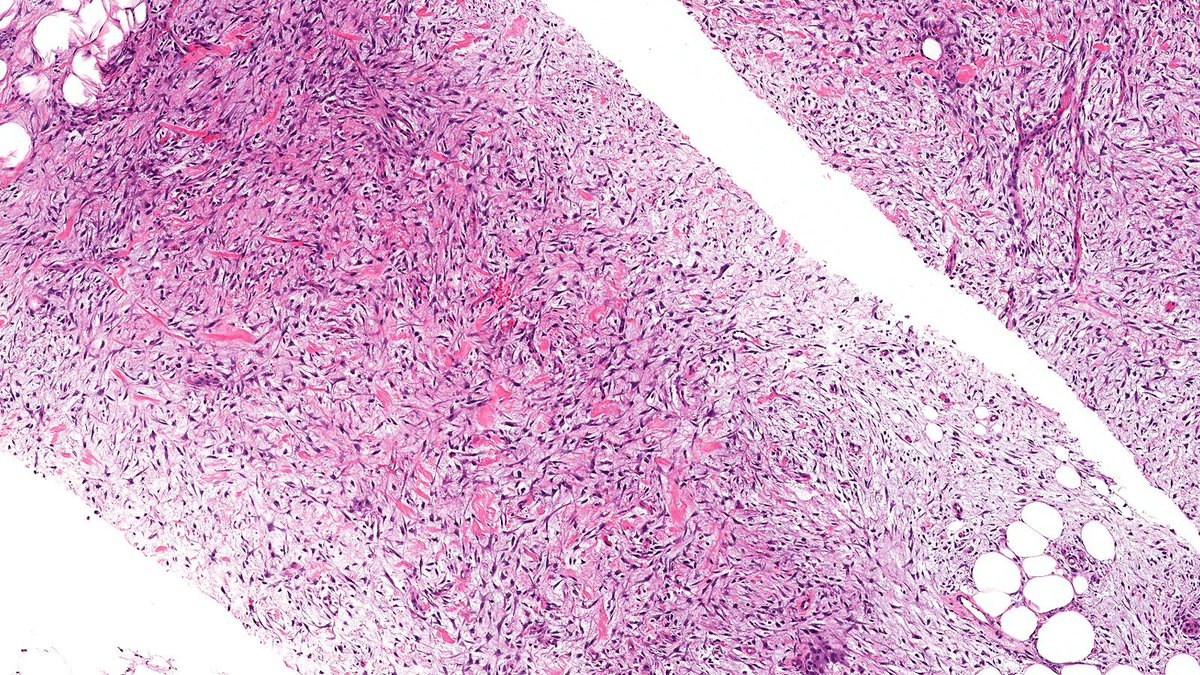Let’s review some spindle cell breast lesions this week

Case of Nodular Fasciitis (NF) 🔬

NF is a self-limited pseudosarcomatous benign neoplasm mimics malignant spindle cell lesions and harbors USP6 gene fusion. NF rarely involves the breast.

#PathTwitter #PathX #breastpath
