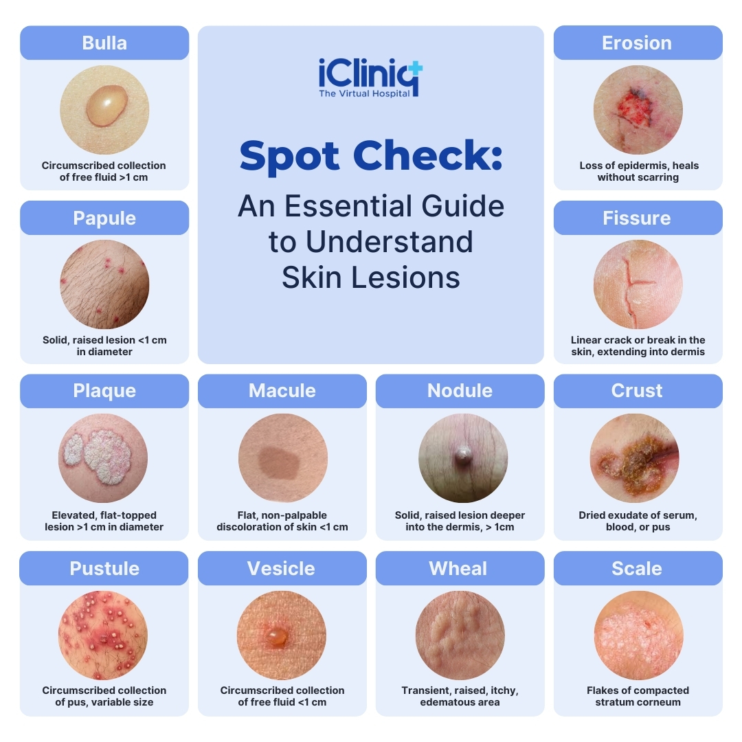 Primary vs Secondary Skin Lesions