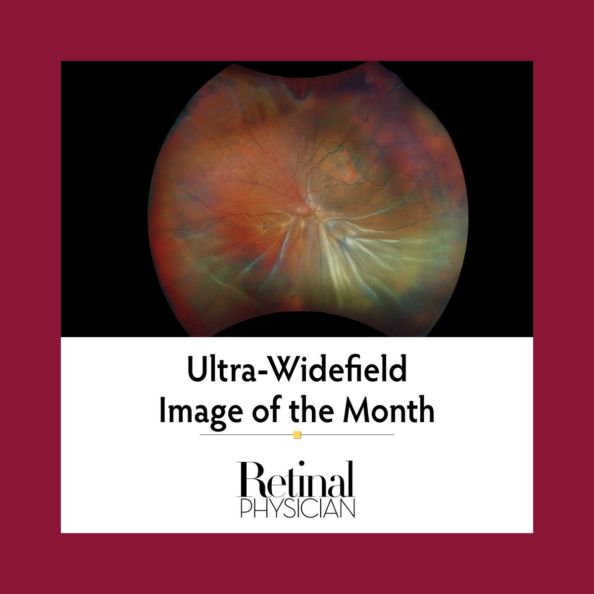 RetinalPhys's tweet photo. View a simultaneous rhegmatogenous retinal detachment and choroidal melanoma in our Ultra-Widefield Image of the Month: https://t.co/XKaa9itwwa
#RetinalPhysician #UWFimaging #Optos #Nikon #conexiant https://t.co/LZr4w3fhMN