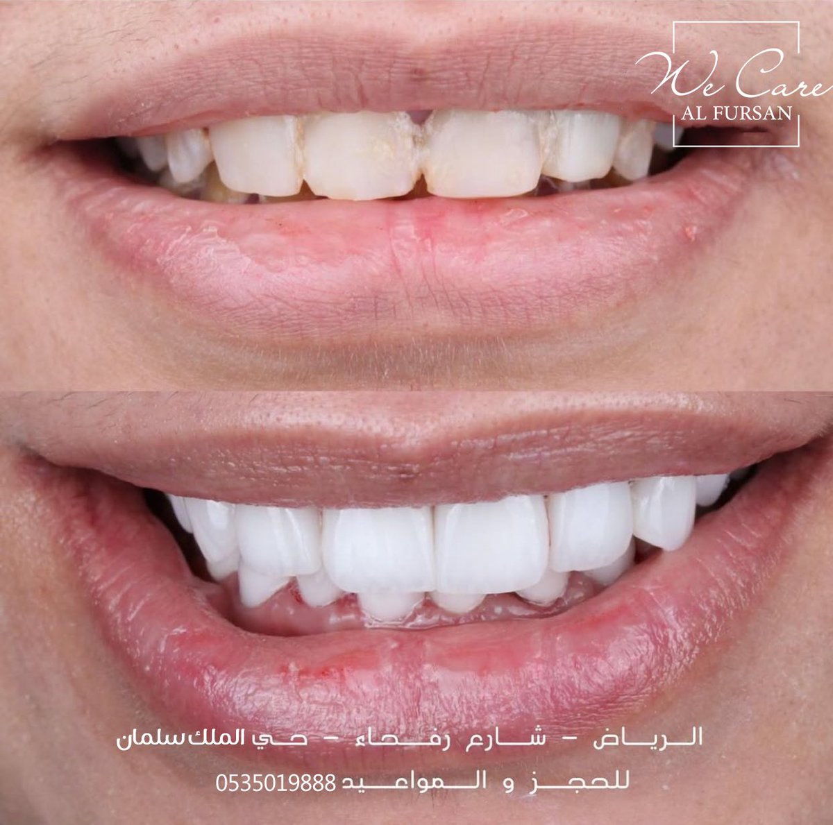 alfursan_mc's tweet photo. جمال ( ابتسامة هوليود ) لما يكون شكلها طبيعي

للمواعيد
0535019888

الرياض/ حي الملك سلمان "الواحه سابقاً" https://t.co/PrQHNh7CTS
