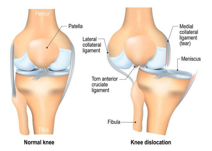 bennwachukwumd's tweet image. #KneeDislocation? Look out for:
🔸 Popping sound
🔸 Swelling and sharp pain
🔸 Knee buckling or feeling unstable
🔸 Visible deformity
Don’t ignore these signs—early treatment is key! medilink.us/akle  #kneehealth
