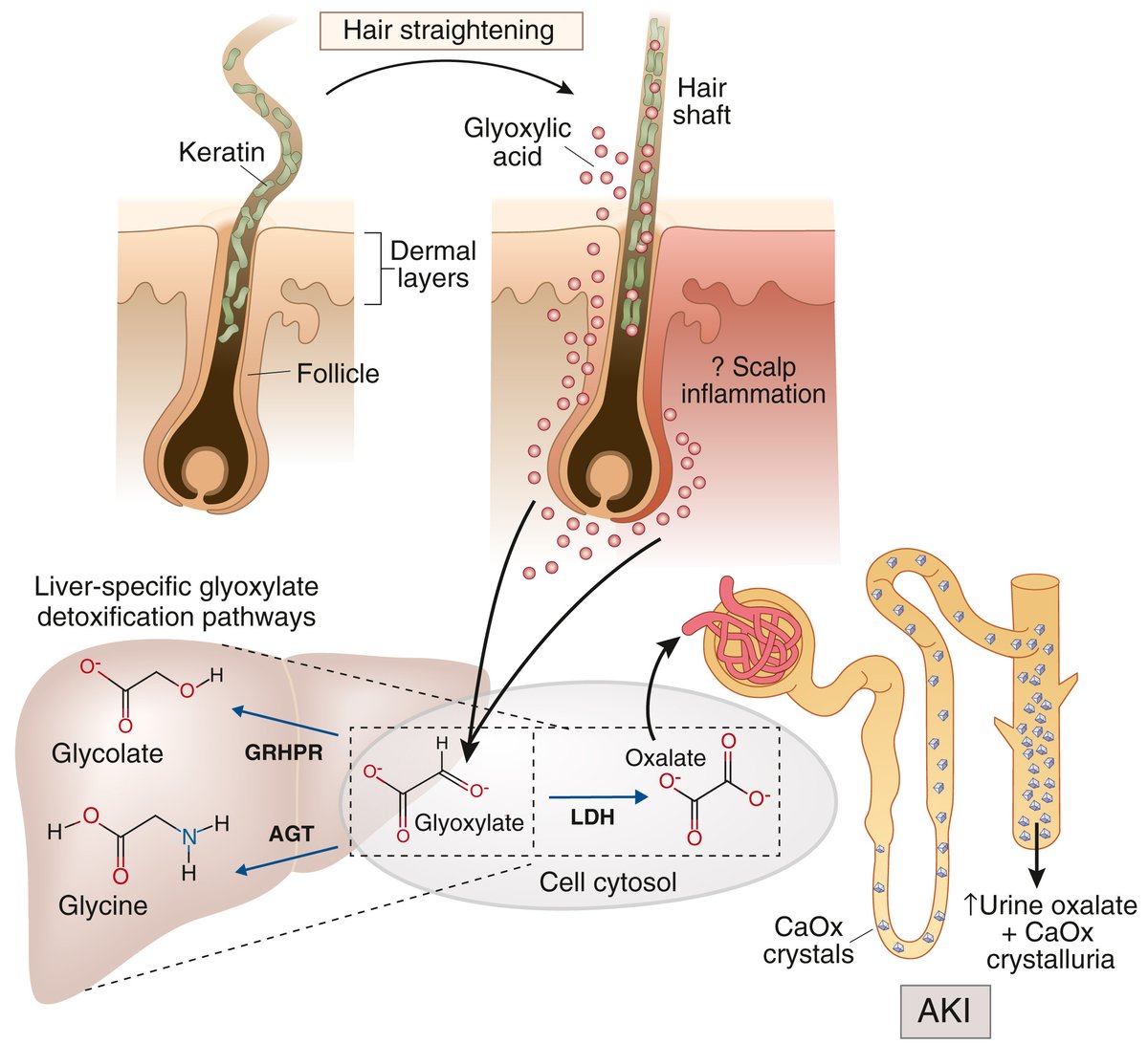 Oxalate nephropathy associated with glyoxylate-containing hair-straightening products: a call for caution

doi.org/10.1016/j.kint…

Original article: doi.org/10.1016/j.kint…

#KICommentary #aki #acutekidneyinjury #oxalatenephrpathy
<a href="/UTSWMedCenter/">UT Southwestern Medical Center</a>