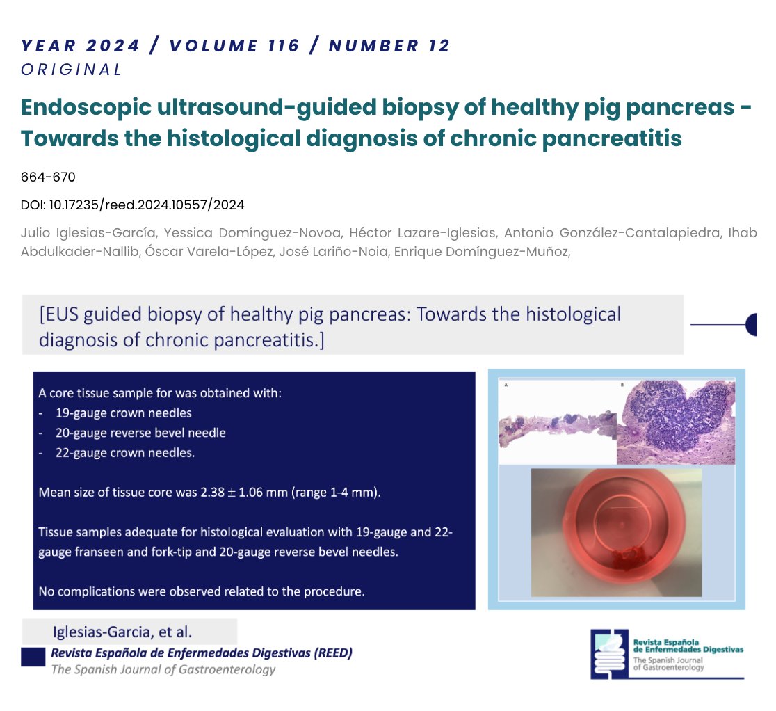Sociedad Española de Patología Digestiva (SEPD) (@sepdigestiva) on Twitter photo Original | <a href="/REEDigestivas_/">Revista Española Enfermedades Digestivas(REED)</a>
📖 Endoscopic ultrasound-guided biopsy of healthy pig pancreas - Towards the histological diagnosis of chronic pancreatitis
🔗 reed.es/endoscopic-ult… <a href="/JulioIglGar/">Julio IglesiasGarcia</a> <a href="/Ydomingueznovoa/">Yessica Dominguez Novoa</a> <a href="/EDominguezMunoz/">J. Enrique Dominguez-Munoz</a> et al.
🔓#OpenAccess
<a href="/GastroCHUSv2/">Gastro SANTIAGO</a> Original | <a href="/REEDigestivas_/">Revista Española Enfermedades Digestivas(REED)</a>
📖 Endoscopic ultrasound-guided biopsy of healthy pig pancreas - Towards the histological diagnosis of chronic pancreatitis
🔗 reed.es/endoscopic-ult… <a href="/JulioIglGar/">Julio IglesiasGarcia</a> <a href="/Ydomingueznovoa/">Yessica Dominguez Novoa</a> <a href="/EDominguezMunoz/">J. Enrique Dominguez-Munoz</a> et al.
🔓#OpenAccess
<a href="/GastroCHUSv2/">Gastro SANTIAGO</a>
