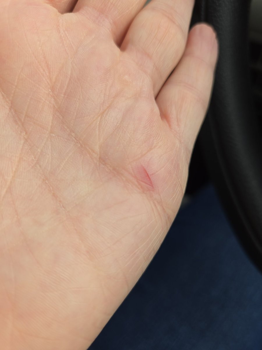 CPAPProtection's tweet image. Had an ALR moment and cut my hand while opening an avocado... stupid circleeee!!