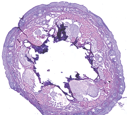 Science Translational Medicine (@sciencetm) on Twitter photo Researchers identify #benzamil as potential treatment for skin #inflammation in #psoriasis mouse and human xenograft skin models. <a href="/StanfordMed/">Stanford Medicine</a> <a href="/UCSFMedicine/">UCSF School of Medicine</a> scim.ag/3BrGtEv Researchers identify #benzamil as potential treatment for skin #inflammation in #psoriasis mouse and human xenograft skin models. <a href="/StanfordMed/">Stanford Medicine</a> <a href="/UCSFMedicine/">UCSF School of Medicine</a> scim.ag/3BrGtEv