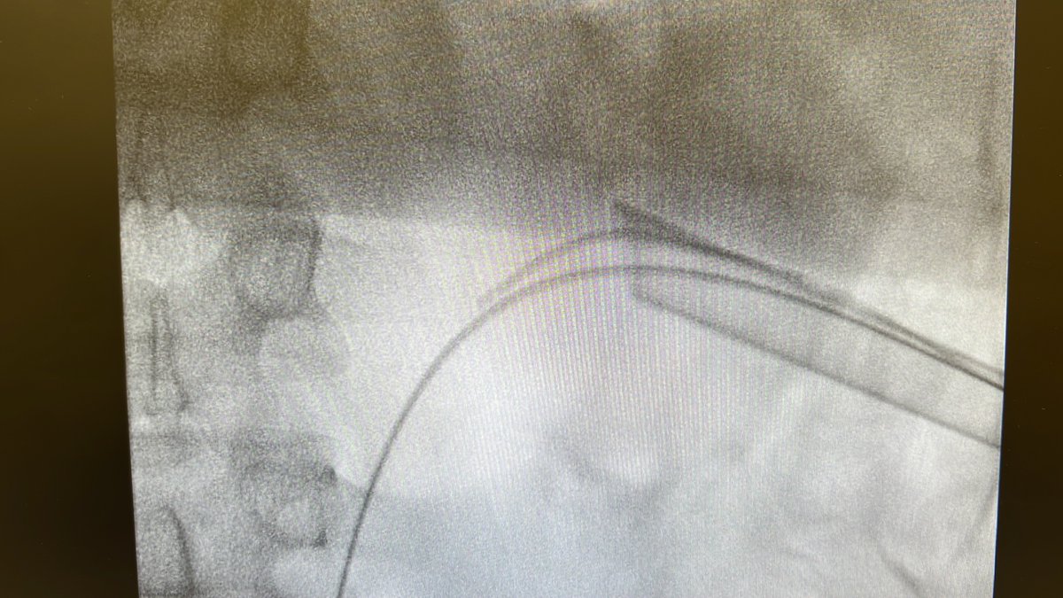 Until High Powered Lasers/FANS/Disposable scopes become Bargainous and Economically Democratised and affirmative actioned , For vast parts of the world PCNL will still rule the Kingdom of Stone