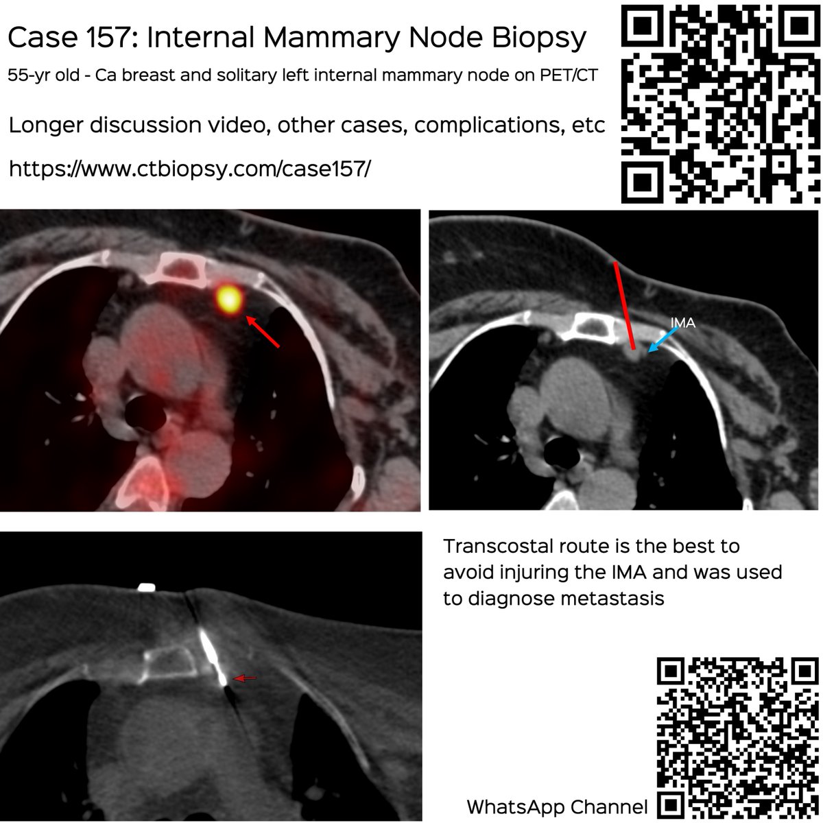 bhavinj's tweet photo. Case 157: Internal Mammary Node Biopsy
Transcostal route
55-yr old Ca breast with new IM node
Video discusses the case, approach to IM node biopsies and complications
https://t.co/ZxG6GfplnP
#ctbiopsy #irrad #internalmammarynode #sentinelnode https://t.co/0ENVGifd09