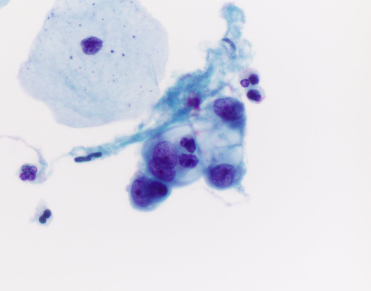 Cervical Pap w/ characteristic IUD effect 

👉Glandular cells w/ vacuolated cytoplasm &amp; w/ increased N:C (nucleoli a helpful benign feature)

👉Sometimes can see intracytoplasmic neuts so beware not to overinterpret as a glandular lesion in pts w/ IUDs

#CytoPath #PathTwitter