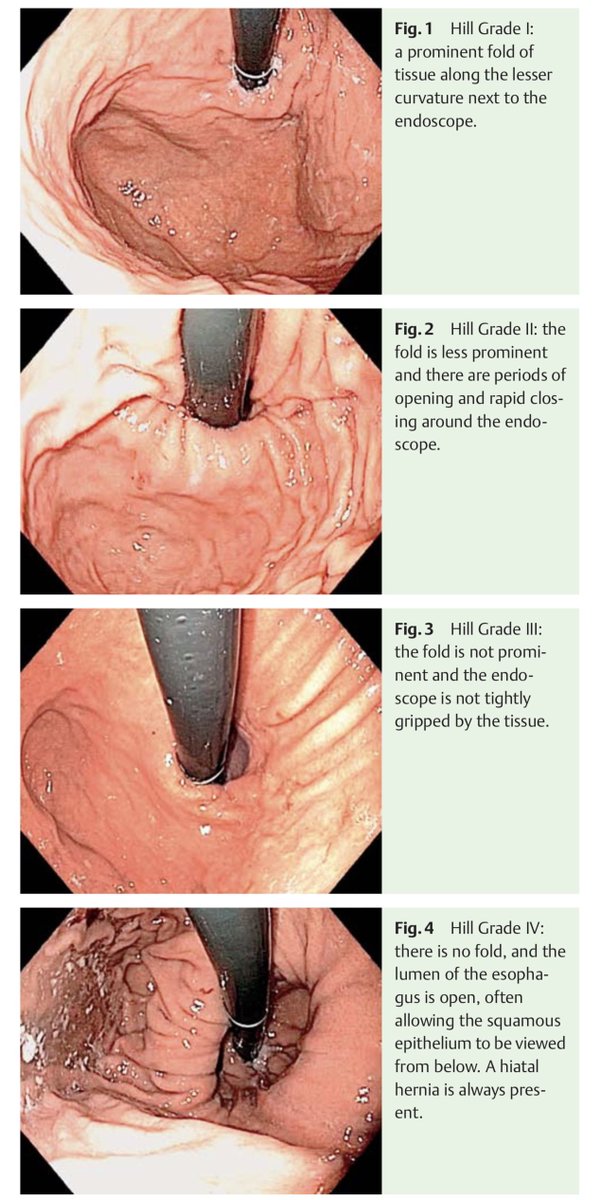 drkeithsiau's tweet photo. A full explanation of Hill grading

https://t.co/mJzggrAufz https://t.co/SgiZNn4bSS