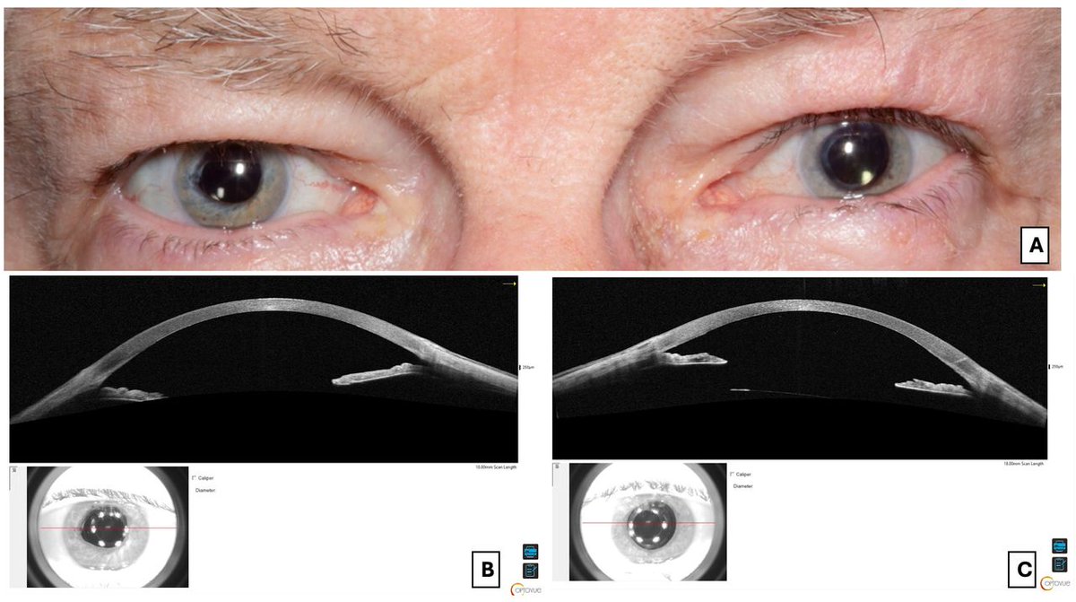 NanavatyMA's tweet photo. Some eyes are just more sensitive to surgeries. A case of bilateral Urrets-Zavalia Syndrome after routine #DMEK surgeries for #fuchsdystrophy just published. Thanks for Ziqiao Qi and @dr_ritika_eye. #cornealtransplant; #pupils; #cornea. Full text at: https://t.co/TStWRNT286. https://t.co/SeUz4UkhPW