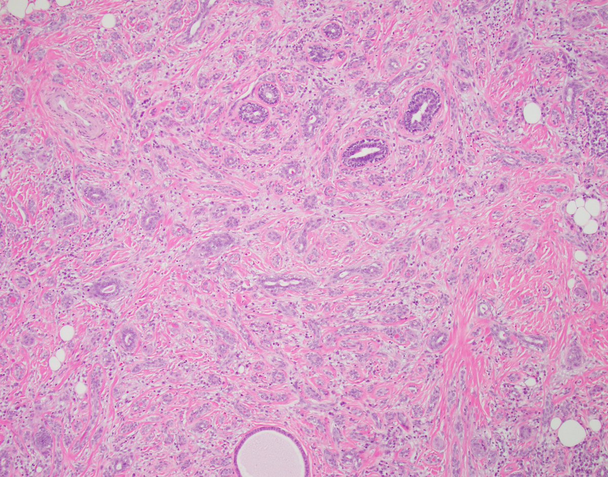 fouad_boulos's tweet image. Thank you all for taking part in the case I posted last Friday. 
I chose one of the trickier fields to share with you, because of its educational value. The additional images provide more insight into the diagnosis.
Let's go over the answers 1 by 1🧵
#breastpath #PathTwitter