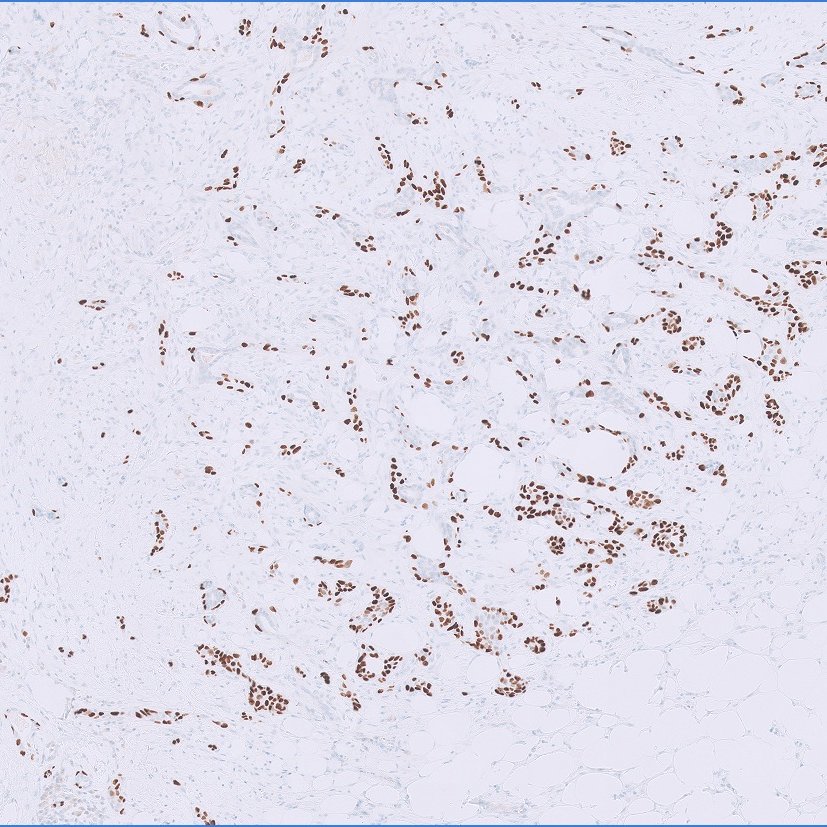 Thank you all for taking part in the case I posted last Friday. 

I chose one of the trickier fields to share with you, because of its educational value. The additional images provide more insight into the diagnosis.

Let's go over the answers 1 by 1🧵

#breastpath #PathTwitter