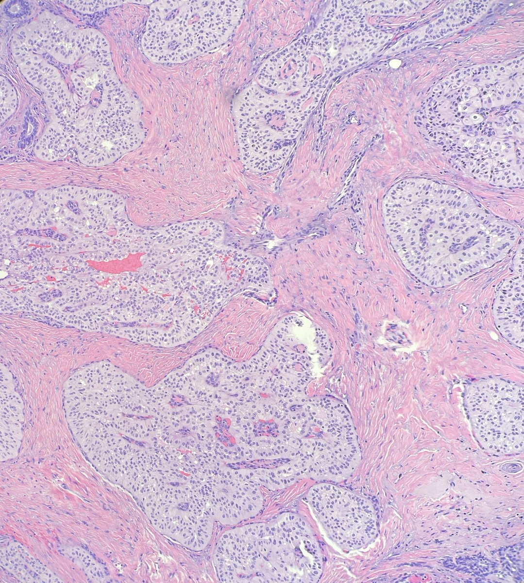55 year-old female, palpable breast mass, ER-, PR-, HER2-, P63- and SMM-.