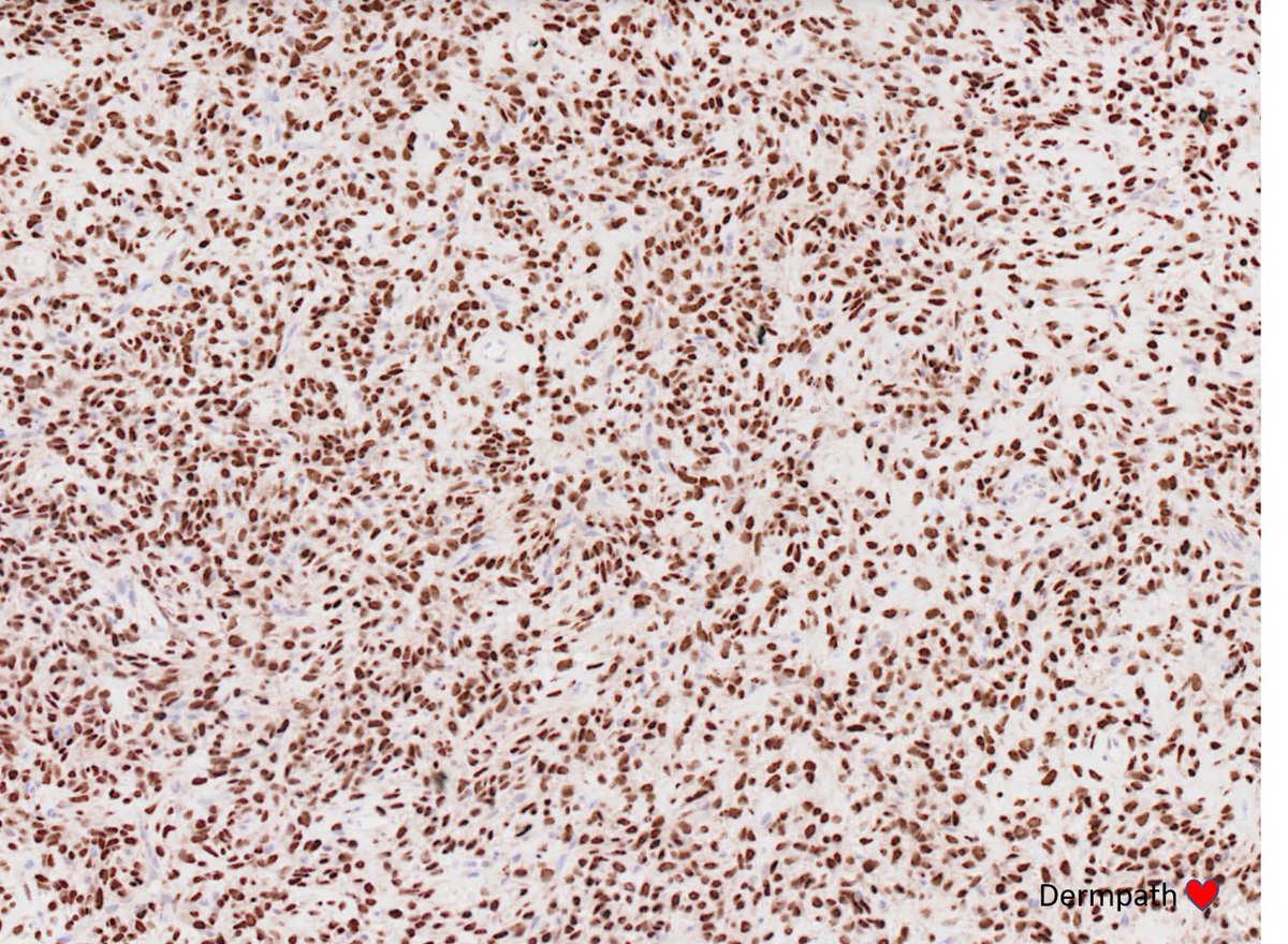 DermpathLove's tweet photo. So - this is an SFT - STAT6 here. Uncommon in superficial soft tissue/subcutis. https://t.co/c47PJF03lv