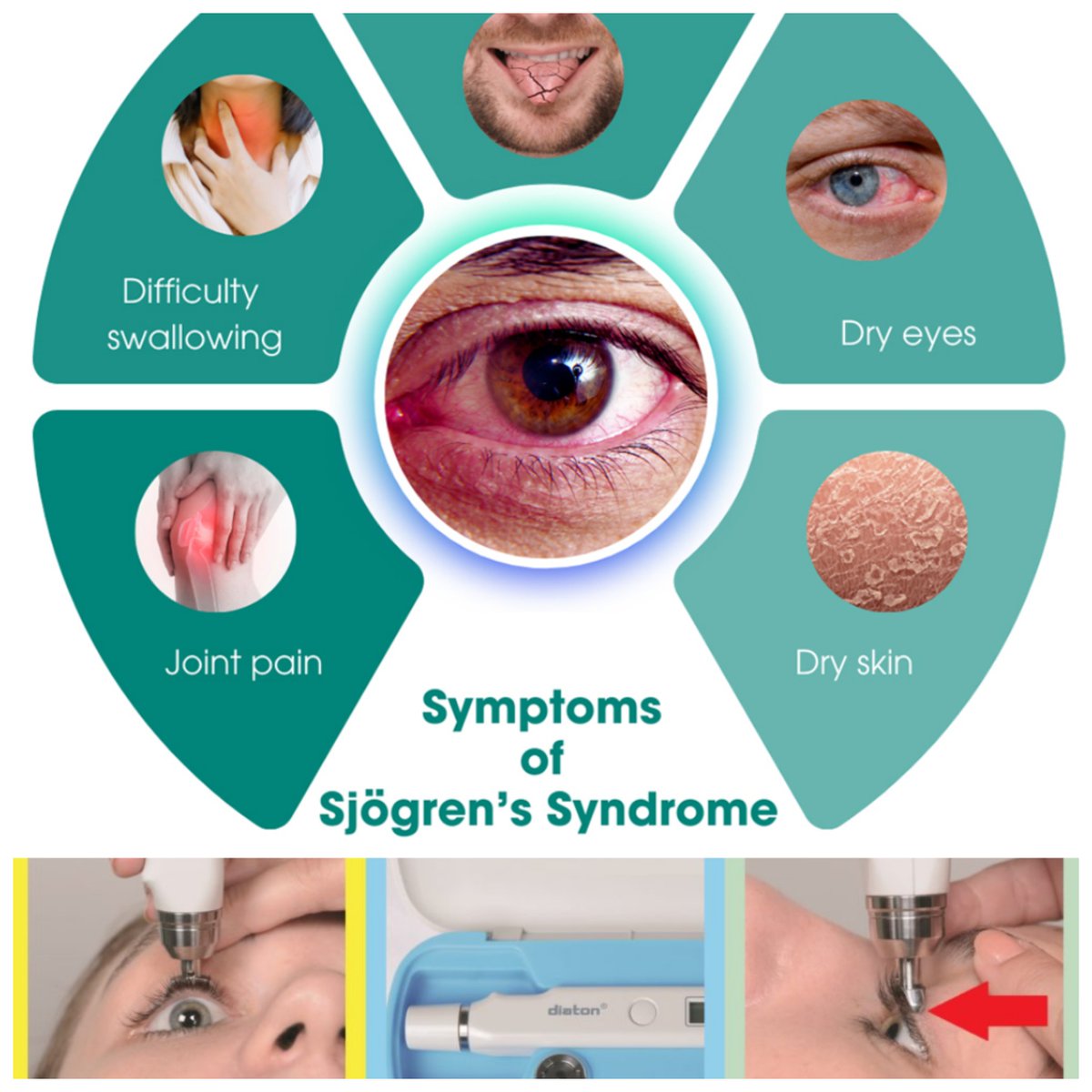 TONOMETER tweet media