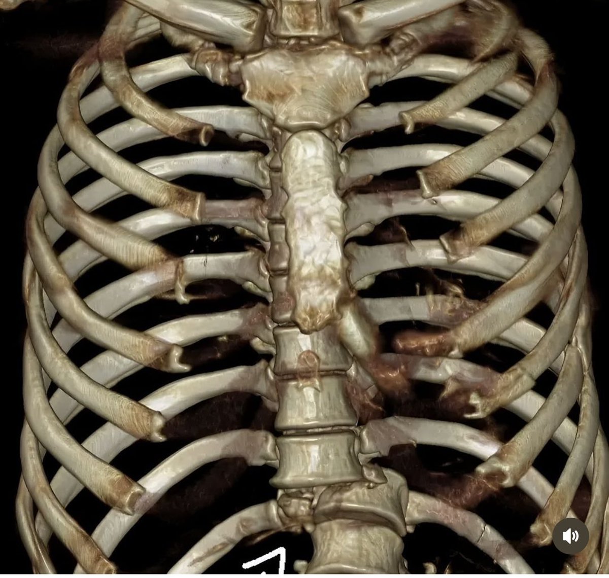 Oren Gottfried, MD tweet media