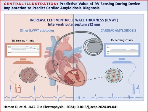 🔴 Predictive Value of RV Sensing During Cardiac Device Implantation to Diagnose Cardiac Amyloidosis <a href="/JACCJournals/">JACC Journals</a> #Cardioed #Cardiology #Amyloidosis #Epeeps