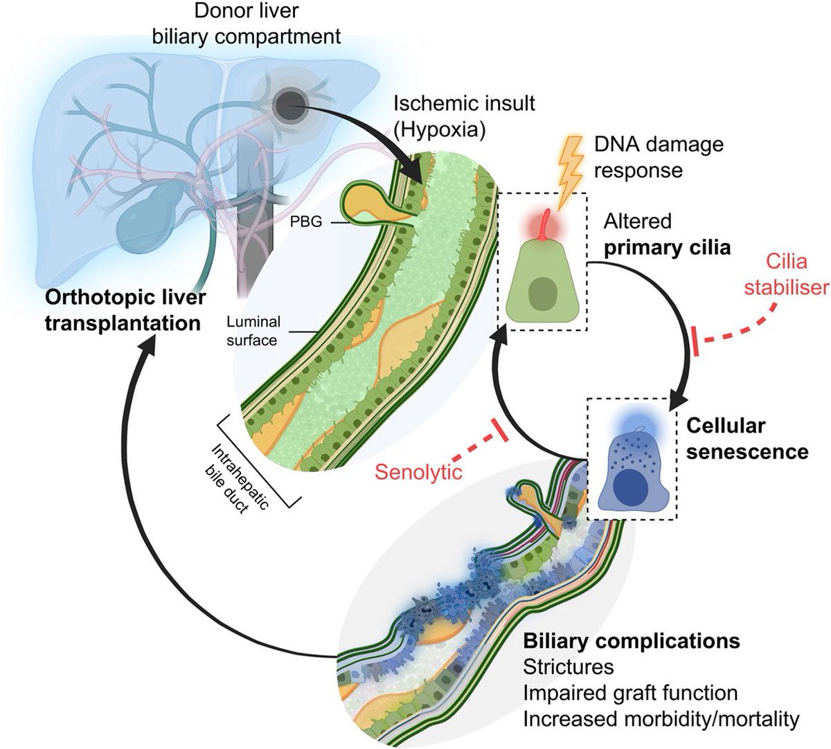 Journal of Hepatology (@jhepatology) on Twitter photo 📌In our December issue
Primary cilia as a targetable node between biliary injury, senescence and regeneration in liver transplantation
#OpenAccess here👉journal-of-hepatology.eu/article/S0168-…
<a href="/HannahEsser1/">Hannah Esser</a>
<a href="/Sofia_fe_gon/">Dr. Sofia Ferreira</a>
#LiverTwitter 📌In our December issue
Primary cilia as a targetable node between biliary injury, senescence and regeneration in liver transplantation
#OpenAccess here👉journal-of-hepatology.eu/article/S0168-…
<a href="/HannahEsser1/">Hannah Esser</a>
<a href="/Sofia_fe_gon/">Dr. Sofia Ferreira</a>
#LiverTwitter
