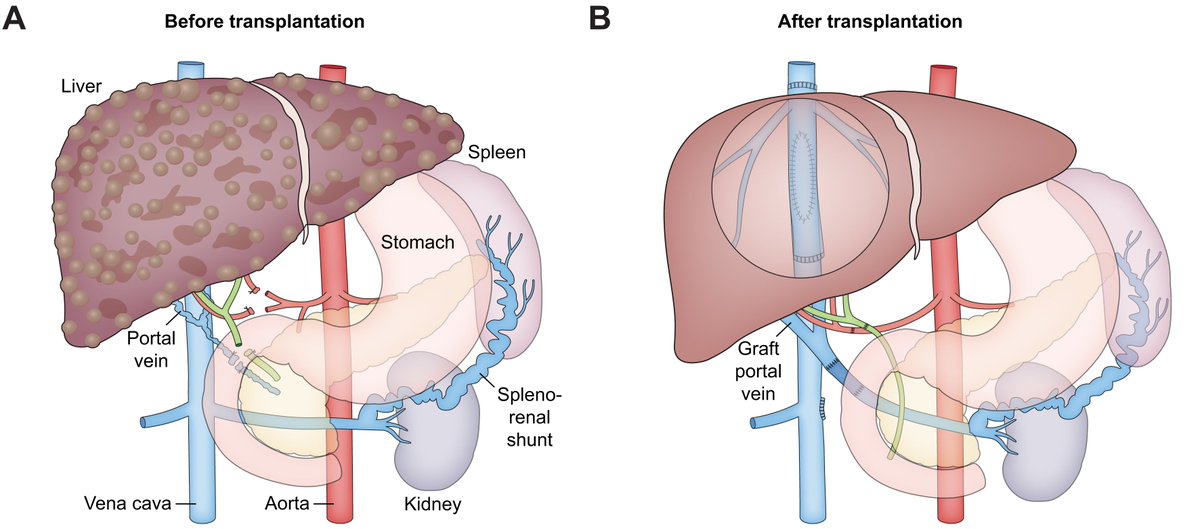 📌In our December issue

EASL Clinical Practice Guidelines on liver transplantation 

Read here👉journal-of-hepatology.eu/article/S0168-…

<a href="/EASLnews/">EASLnews</a> 
<a href="/EASLedu/">EASL Education</a> 
#LiverTwitter