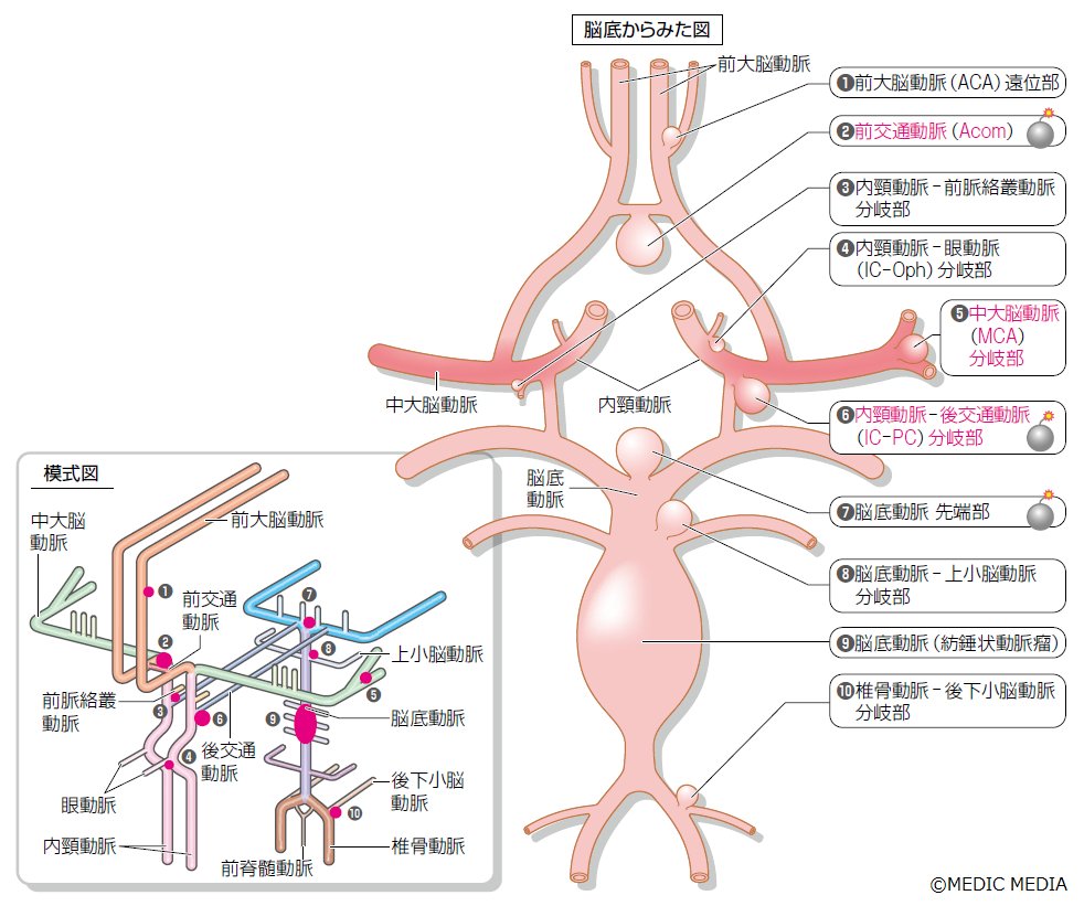 脳 動脈 瘤 好 発 部位