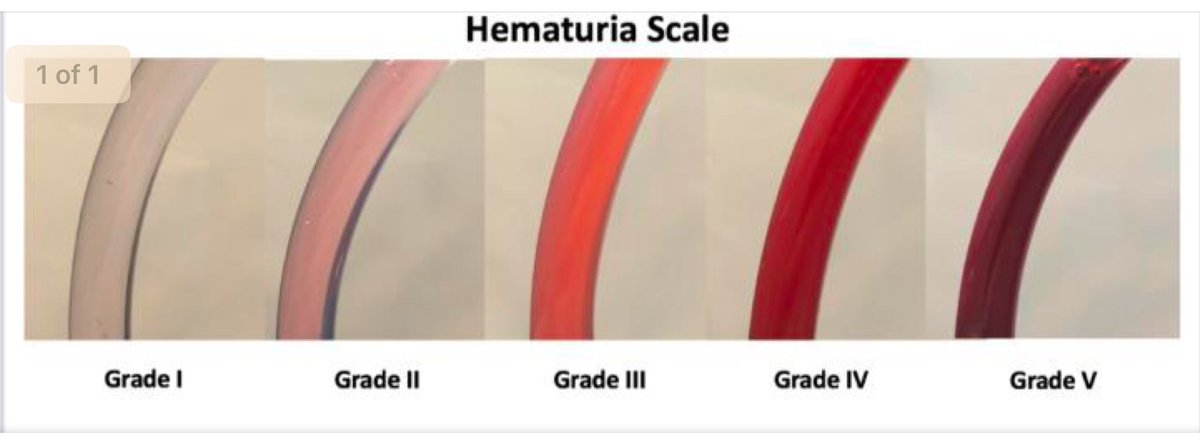 “Grade 3 and below, they can go.”

My mantra of outpatient urological surgery.
