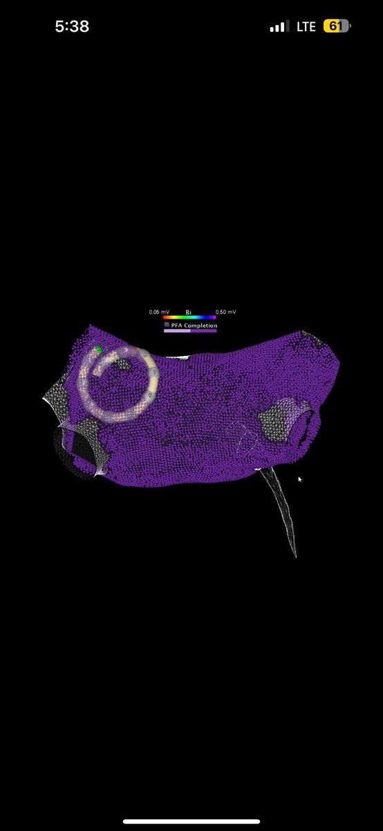 Luigi Di Biase (@luigidibiasemd) on Twitter photo Outstanding experience today at Einstein Montefiore with 5 cases of VARIPULSE PFA+CARTO+ the clarity of the NEW ICE with the CRYSTAL integration.#EPeeps #Varipulse #PFA <a href="/jjmt_ep/">Johnson & Johnson MedTech | Electrophysiology</a> <a href="/MonteHeart/">Montefiore Heart</a> <a href="/MontefioreNYC/">Montefiore Health System</a> <a href="/EinsteinMed/">Albert Einstein College of Medicine - Official</a> <a href="/AndyZhangMD/">Xiaodong Zhang (Andy), MD, PhD, FHRS, FACC</a> <a href="/danpugliesemd/">Dr. Dan</a> <a href="/WPHospital/">White Plains Hospital</a> <a href="/GrupposoVito/">Vito Grupposo</a> Outstanding experience today at Einstein Montefiore with 5 cases of VARIPULSE PFA+CARTO+ the clarity of the NEW ICE with the CRYSTAL integration.#EPeeps #Varipulse #PFA <a href="/jjmt_ep/">Johnson & Johnson MedTech | Electrophysiology</a> <a href="/MonteHeart/">Montefiore Heart</a> <a href="/MontefioreNYC/">Montefiore Health System</a> <a href="/EinsteinMed/">Albert Einstein College of Medicine - Official</a> <a href="/AndyZhangMD/">Xiaodong Zhang (Andy), MD, PhD, FHRS, FACC</a> <a href="/danpugliesemd/">Dr. Dan</a> <a href="/WPHospital/">White Plains Hospital</a> <a href="/GrupposoVito/">Vito Grupposo</a>