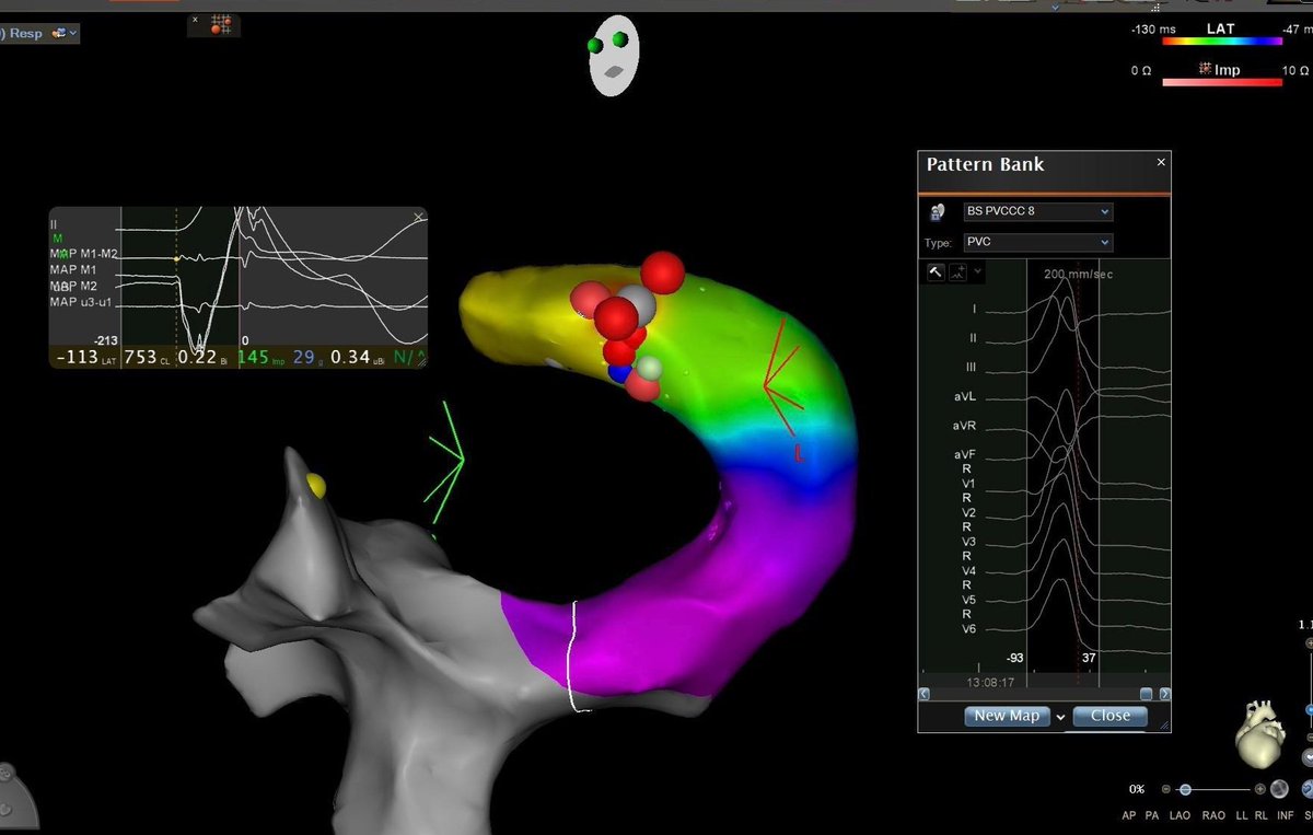 James Kneller, M.D., Ph.D., FHRS (@jamesknellermd) on Twitter photo #PVC from the #GCV post #TAVR. Is there an association? @Epeeps_Bot #Epeeps #CardioTwitter <a href="/uazmedphx/">UAZ Medicine - Phoenix</a> <a href="/GoLakeHavasu/">Go Lake Havasu</a> <a href="/havasunews/">Today's News Herald</a> <a href="/HavasuChamber/">Havasu Area Chamber</a> @BiosenseWebster <a href="/therealKedarB/">Kedar Balakrishna</a> <a href="/EPTMArizonaLFG/">Shane Brian</a> #PVC from the #GCV post #TAVR. Is there an association? @Epeeps_Bot #Epeeps #CardioTwitter <a href="/uazmedphx/">UAZ Medicine - Phoenix</a> <a href="/GoLakeHavasu/">Go Lake Havasu</a> <a href="/havasunews/">Today's News Herald</a> <a href="/HavasuChamber/">Havasu Area Chamber</a> @BiosenseWebster <a href="/therealKedarB/">Kedar Balakrishna</a> <a href="/EPTMArizonaLFG/">Shane Brian</a>