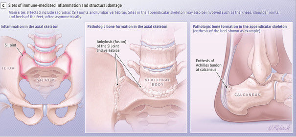 Excited to share our article about axial spondyloarthritis that was just published in JAMA! ⁦⁦<a href="/JAMA_current/">JAMA</a>⁩ #education #early_diagnosis #close_the_gap #axial_spondyloarthritis #axSpA #ankylosing_spondylitis #AS pubmed.ncbi.nlm.nih.gov/39630439/