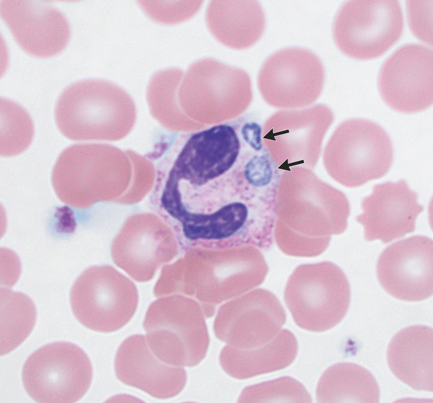 guerreroespejo's tweet image. A 58-y-o♂️, splenectomy, lived on a farm in New York: fatigue, fever, headache, &amp;amp; scleral icterus
Leukocytosis,⬆️D Bil, AST, ALT &amp;amp; ALP
🔬blood smear: segmented neutrophils with abnormal intracytoplasmic inclusions (arrows).
1/2

DOI: 10.1056/NEJMicm2408847
#idxposts #microbiology