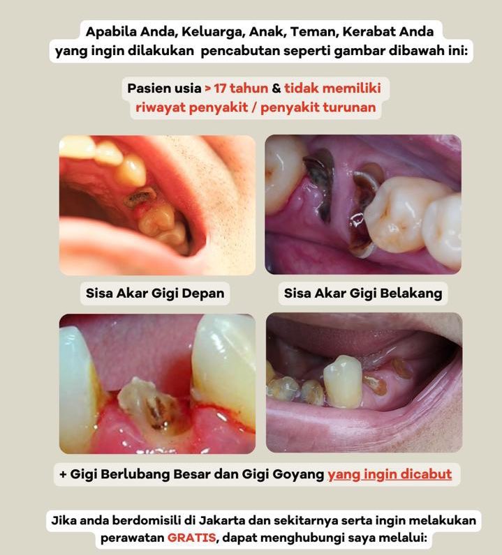 hilalalahihi's tweet photo. Halo temen temen aku lagi nyari pasien untuk cabut akar gigi ataupun goyang bagian depan atas dan bawah jika berminat bisa dm yaaa tanpa dipungut biaya dirawat dengan dokter coass ๐๐๐๐๐ค๐ค๐ค #koasgigi #SpotifyWrapped #copot #GranHermano2025 https://t.co/d17Y1beJmu