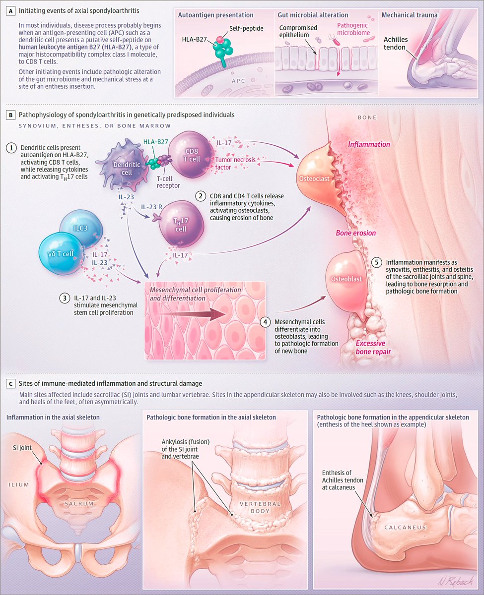 PhysioMeScience's tweet photo. Just published in JAMA 🔥

Axial Spondyloarthritis - A Review

👇👇👇

https://t.co/r817R7cluq https://t.co/ULJ8gwxh2R