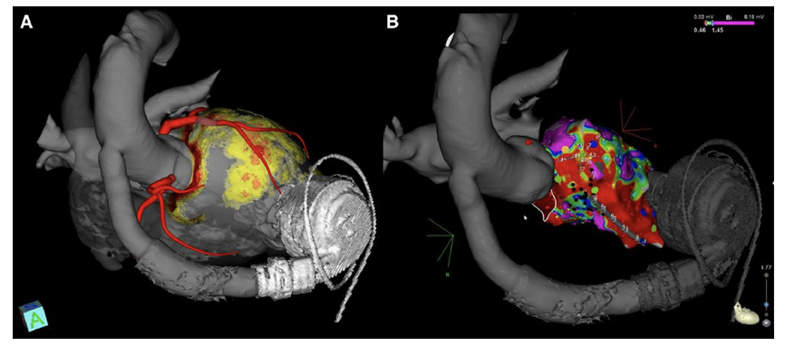 Jacopo Imberti (@jacopoimberti) on Twitter photo Must read 🆕 #ESC_EHRA Consensus Paper on arrhythmia management in #LVAD pts. tinyurl.com/5cn7en7d
Focus on:
🔎Drug therapy
🔎Catheter ablation
🔎Peri-procedural aspects
<a href="/EHRAPresident/">EHRAPresident</a> <a href="/ESCStrokeChair/">ESC Council on Stroke Chairperson</a> <a href="/escardio/">European Society of Cardiology</a> <a href="/EuropaceEiC/">Europace Editor-in-Chief</a> <a href="/sozi81/">Antonio Frontera</a> <a href="/Petr_Peichl/">Petr Peichl</a> <a href="/EPDeneke/">Thomas Deneke</a> @simivicst #EPeeps Must read 🆕 #ESC_EHRA Consensus Paper on arrhythmia management in #LVAD pts. tinyurl.com/5cn7en7d
Focus on:
🔎Drug therapy
🔎Catheter ablation
🔎Peri-procedural aspects
<a href="/EHRAPresident/">EHRAPresident</a> <a href="/ESCStrokeChair/">ESC Council on Stroke Chairperson</a> <a href="/escardio/">European Society of Cardiology</a> <a href="/EuropaceEiC/">Europace Editor-in-Chief</a> <a href="/sozi81/">Antonio Frontera</a> <a href="/Petr_Peichl/">Petr Peichl</a> <a href="/EPDeneke/">Thomas Deneke</a> @simivicst #EPeeps