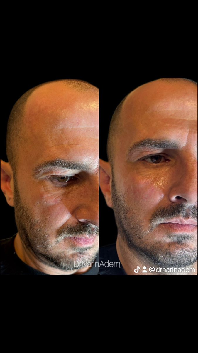 NariArdeni's tweet photo. Facial aesthetics for men.
• Facial aesthetics for men.
Procedure: volume restoration in the midface/median bulge area in men
* Purpose: restoration of deep fat deposits in the midface area

used #cheekbones #fillers #fillerisamzhe #tiktokdermatologist #fillerskule https://t.co/nGDBM06Ihe
