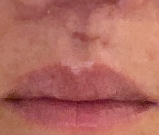 1週間ぶりの波動療法。
施術直後、全身が温かくなり、体が軽くなった。

人中のキズはかなり小さくなり、ムチウチの首や肩もだいぶ軽くなってきた。

鼻骨骨折と内出血によるおでこのたんこぶは、もう少しかかりそう。

#はたともこ