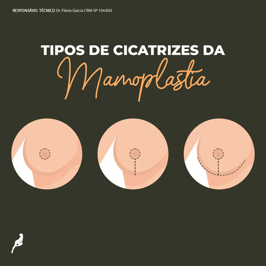 Vem conferir os tipos de cicatrizes de MAMOPLASTIA.

< plasticadosonho.com.br > 

#DreamPlastic #CirurgiaPlastica #Mamoplastia