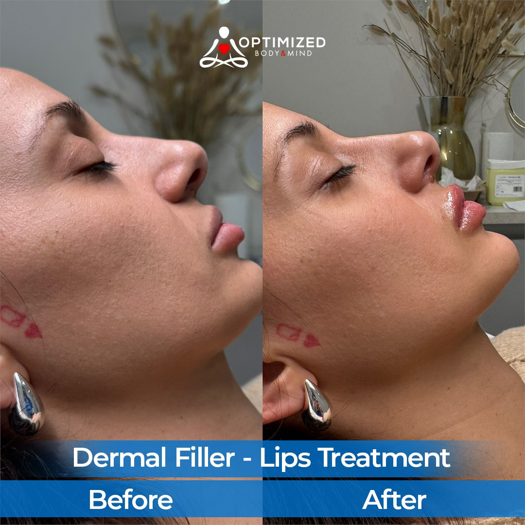 OptimizedBandM's tweet photo. Enhance your lips with trusted experts at Optimized Body &amp; Mind💉💋

💥 Limited Time Offer:
Now £𝟏𝟏𝟓 (was £190) – Get up to 40% OFF

📅 Book Your Lips Fillers Appointment Today:
👉 https://t.co/rU9hySicNC

#optimizedbodyandmind #dermalfiller #lipfillers #luton #beforeandafter https://t.co/QhicJE2Rvy