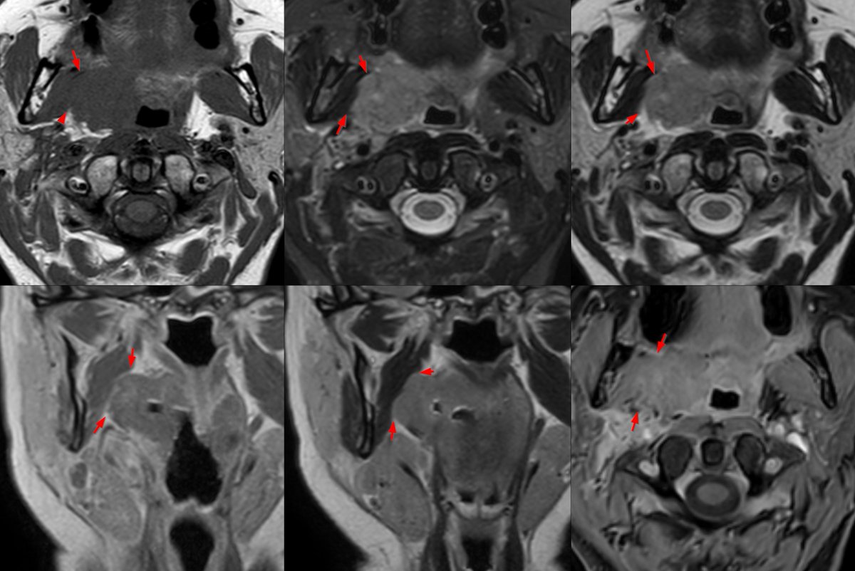 #HNImaging #HNRad <a href="/rhwiggins/">Richard Wiggins</a> <a href="/amyfjuliano/">Amy Juliano</a>  <a href="/callyrobs/">Caroline Robson, MBChB</a> <a href="/DShatzkes/">Deborah Shatzkes</a> <a href="/FeliceDArco/">Felice D'Arco</a> <a href="/LorenzoPinelli/">Lorenzo Pinelli</a> Have a question that has sparked a discussion at our department. Tonsillary CA. Native T1 TSE 3 mm ax no fat line. Other sequencies show a thin line. Muscle signal OK. Invasion or not?