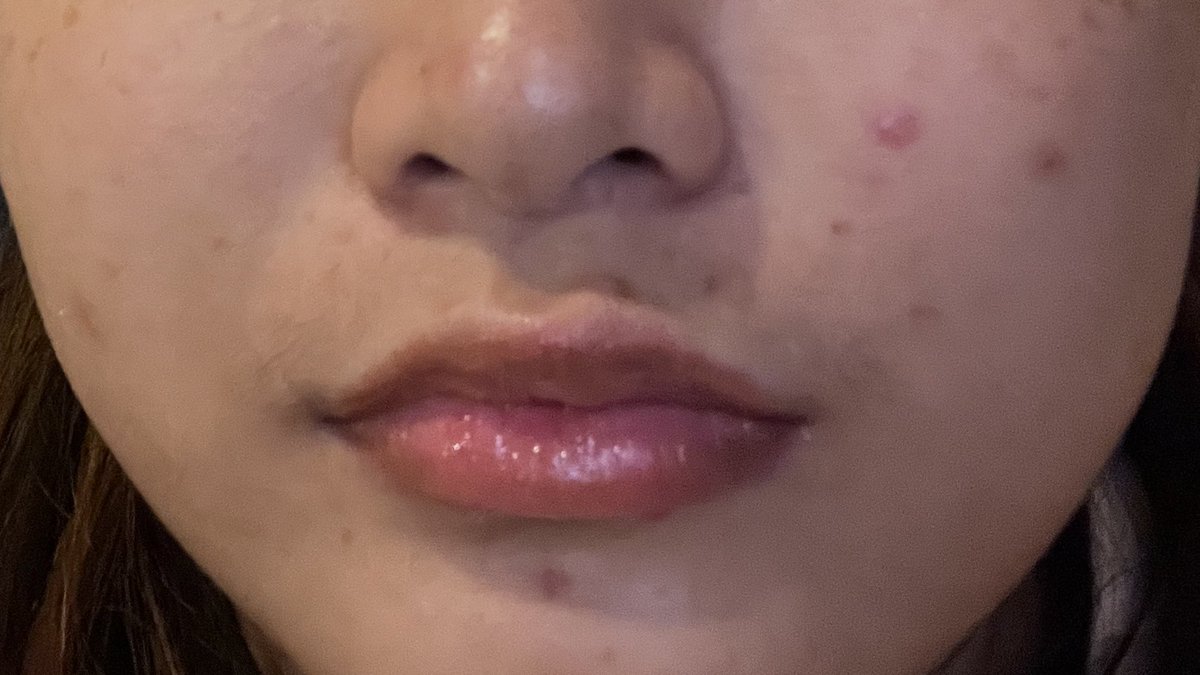 g0dlymschievous's tweet photo. มารีวิวผลการใช้ Eucerin Pro ACNE Triple Effect Serum ฮะ ส่วนตัวเคยใช้ตัว Dark Spot ของ Eucerin อยู่แล้วและผลลัพธ์น่าพอใจมาก ช่วงนี้สิวเห่อเลยลองมาใช้ตัวนี้ดู ผลคือรอยจางไวกว่าที่คิด นี่ว่าจะใช้ต่อเนื่องยาวๆเลย 

#EucerinThailand 
#EucerinTripleEffectSerum 
#EucerinGeltoFoam https://t.co/qYIvm7RFUi