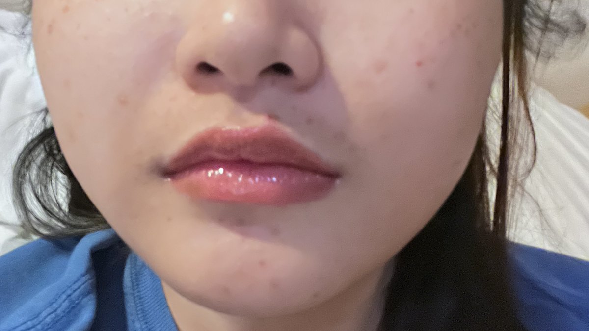 g0dlymschievous's tweet photo. มารีวิวผลการใช้ Eucerin Pro ACNE Triple Effect Serum ฮะ ส่วนตัวเคยใช้ตัว Dark Spot ของ Eucerin อยู่แล้วและผลลัพธ์น่าพอใจมาก ช่วงนี้สิวเห่อเลยลองมาใช้ตัวนี้ดู ผลคือรอยจางไวกว่าที่คิด นี่ว่าจะใช้ต่อเนื่องยาวๆเลย 

#EucerinThailand 
#EucerinTripleEffectSerum 
#EucerinGeltoFoam https://t.co/qYIvm7RFUi