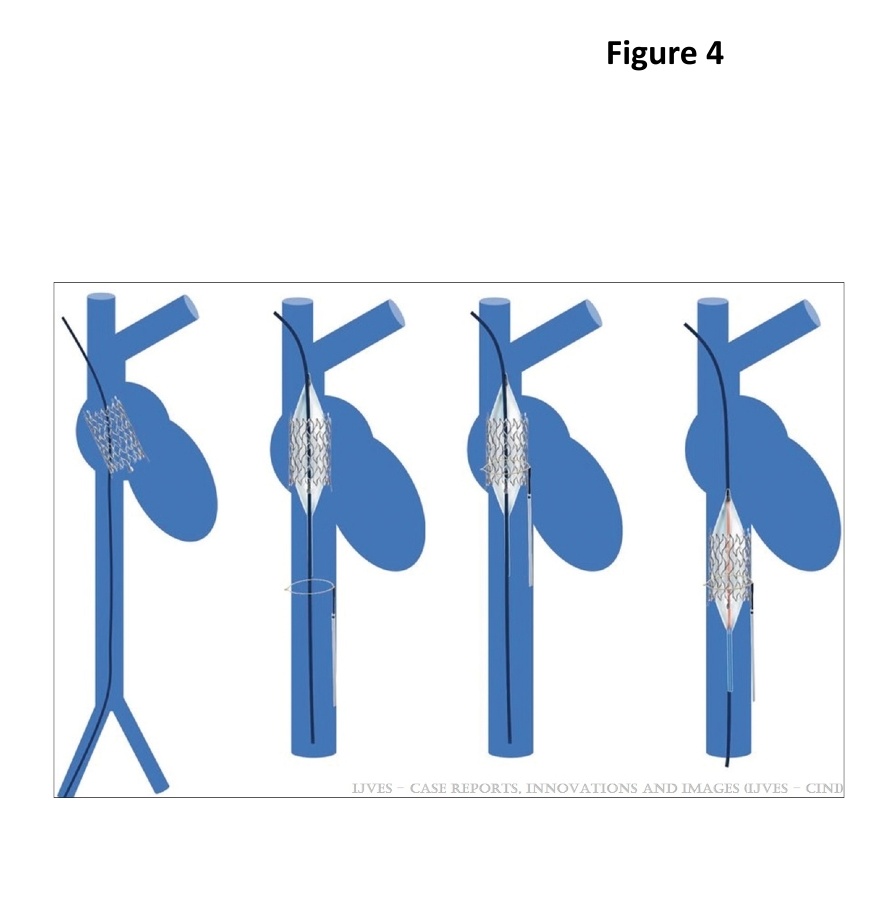 vsijournalijves's tweet photo. What happens when a stent dislodges into the right atrium?
This fascinating case study by @VarenyamVasc outlines a practical, life-saving technique using a combination of a snare and balloon to retrieve an 18mm dislodged stent. #MedTwitter
#endovascular https://t.co/t5tj24aYg9