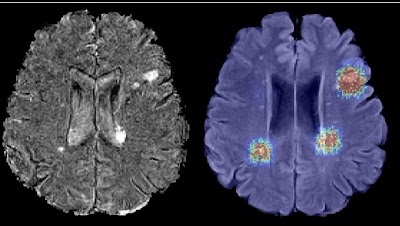 Radiology_AI's tweet image. #DataAugmentation with synthetic patient data substantially improved performance of #AI models doi.org/10.1148/ryai.2… @Alex_Radbruch @GianBrugna @DZNE_en #MRI #SyntheticData #MachineLearning