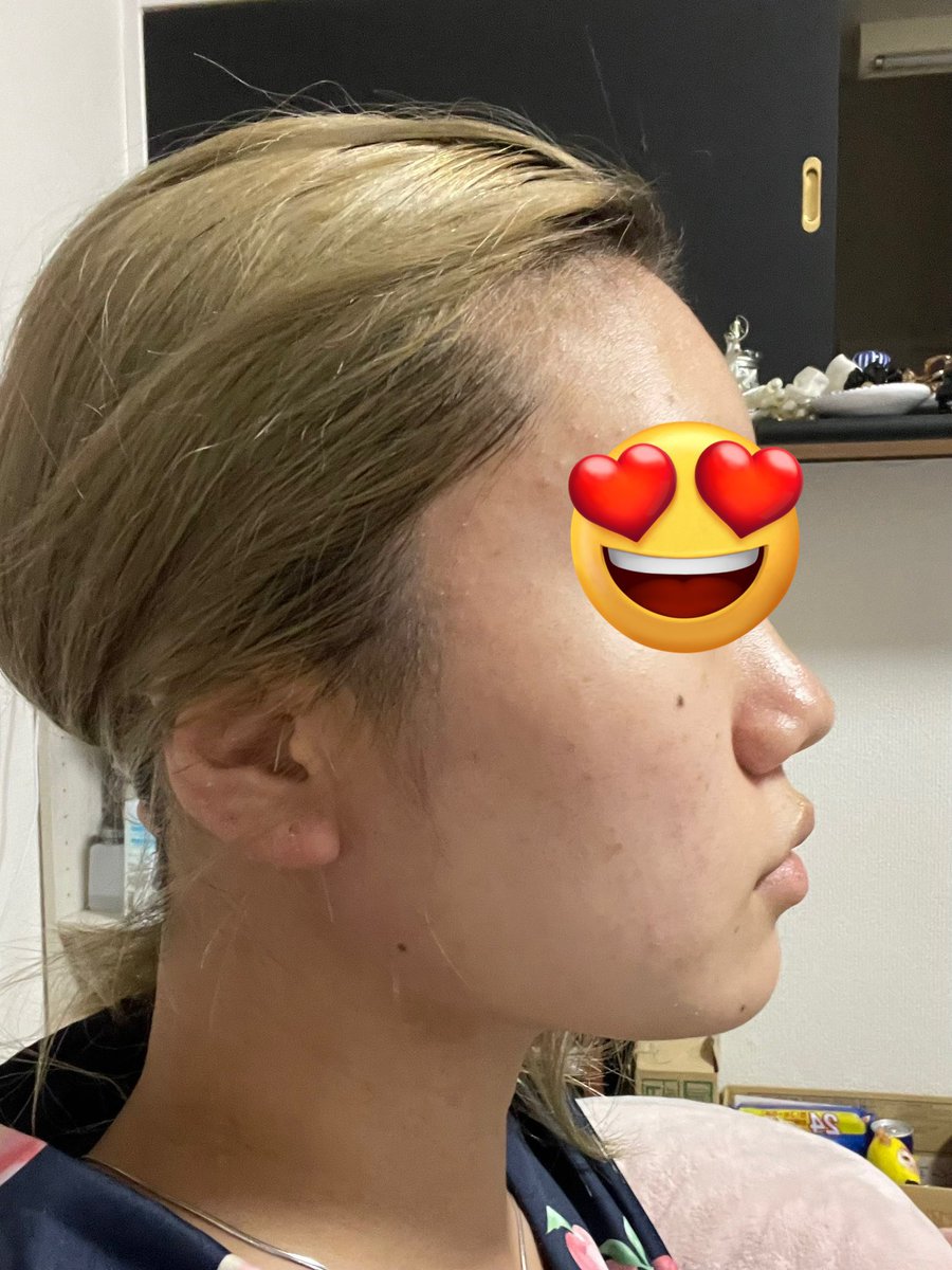 M_kuma135's tweet photo. 左:before
右:after

顔の脂肪吸引してもう3週間が経ちました👀

右は3週間後の経過のノーマル写真です！
だいぶ腫れも落ち着いてきて顔の輪郭もはっきりし始めてきた！！！
まだまだ口は完全には開かないし、触ったら固いけど数ヶ月後の仕上がりがほんとに楽しみすぎる🥰 https://t.co/MCc0URKFqp