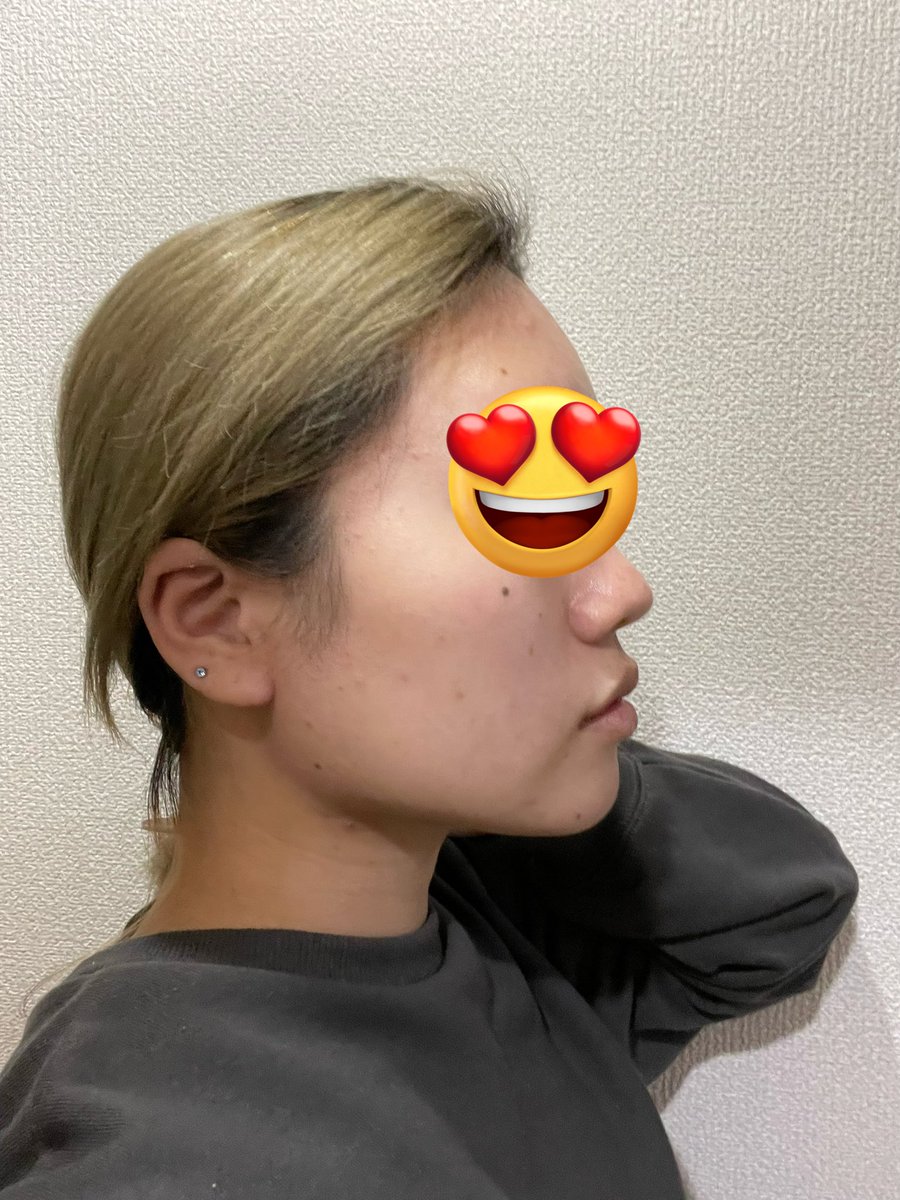 M_kuma135's tweet photo. 左:before
右:after

顔の脂肪吸引してもう3週間が経ちました👀

右は3週間後の経過のノーマル写真です！
だいぶ腫れも落ち着いてきて顔の輪郭もはっきりし始めてきた！！！
まだまだ口は完全には開かないし、触ったら固いけど数ヶ月後の仕上がりがほんとに楽しみすぎる🥰 https://t.co/MCc0URKFqp