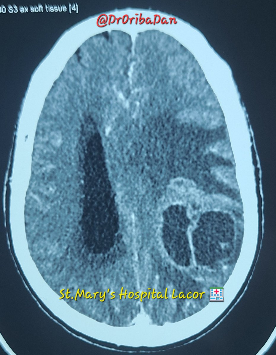 DrOribaDan's tweet image. A 56y/M, HIV-negative, presented with a headache &amp;amp; status epilepticus. The patient has no h/o trauma, smoking, &amp;amp; reports occasional alcohol use.
⁉️Interprete the CT-scan &amp;amp; make a diagnosis
📚Suggest mgt for above condition.
@rkalyes1 @lacor_hospital @MakCHS_SOM @InternalmedMak