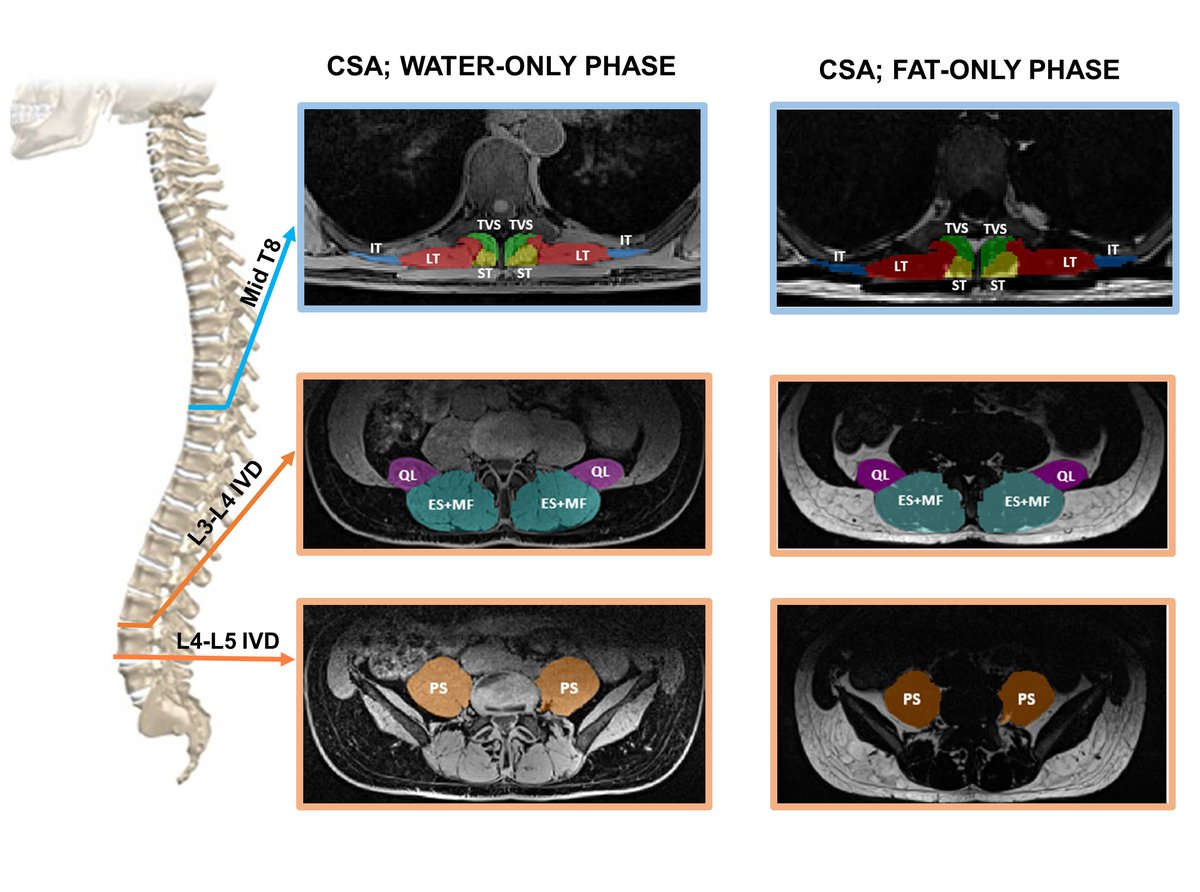 Wake Forest Biomedical Engineering (@wakebme) on Twitter photo 🚀#NewPub alert!
"Thoracolumbar Spine Muscle Changes in Long-Duration Space Missions" by Dr. <a href="/AshleyAWeaver/">Ashley A. Weaver, PhD</a> & PhD grad student <a href="/luis_pov4/">Luis Poveda</a>
🌟 Check out these key insights into how space travel affects spinal muscles 👉sciencedirect.com/science/articl…
<a href="/KaranDevane/">Karan Devane</a> @dianaa_madrid <a href="/ToozeJanet/">Janet Tooze</a> 🚀#NewPub alert!
"Thoracolumbar Spine Muscle Changes in Long-Duration Space Missions" by Dr. <a href="/AshleyAWeaver/">Ashley A. Weaver, PhD</a> & PhD grad student <a href="/luis_pov4/">Luis Poveda</a>
🌟 Check out these key insights into how space travel affects spinal muscles 👉sciencedirect.com/science/articl…
<a href="/KaranDevane/">Karan Devane</a> @dianaa_madrid <a href="/ToozeJanet/">Janet Tooze</a>