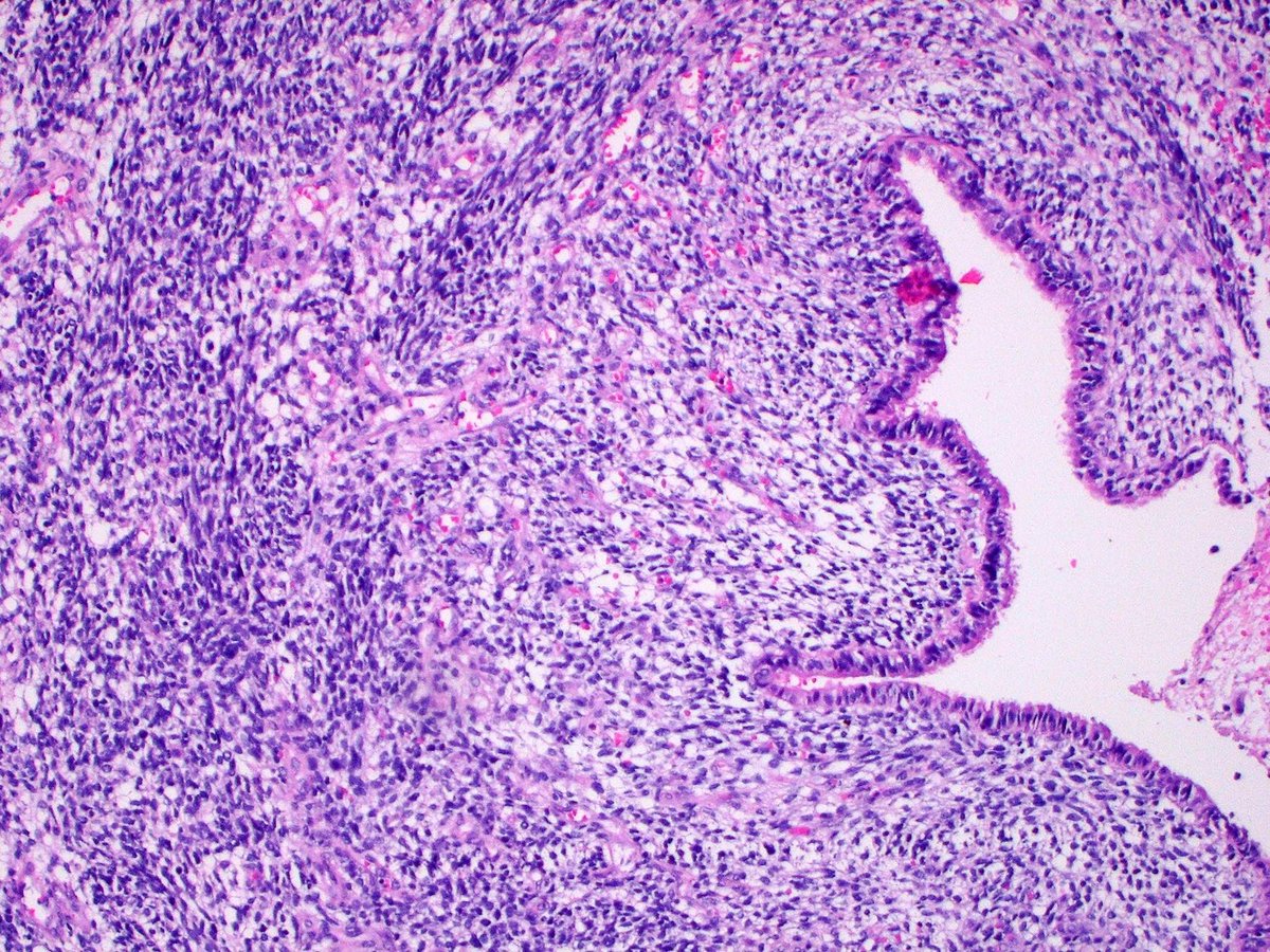 CuringN's tweet photo. Lung - What's your diagnosis?

Topic link: https://t.co/Q31AfBCfUZ

Images contributed by Aliya N. Husain, M.D.

Visit our CCN blog for cancer-related essays by Dr. Pernick: https://t.co/aaLBk9B2jb.

#Cancer #CancerResearch #CuringCancerNetwork #Pathology https://t.co/dUaR18f8RI