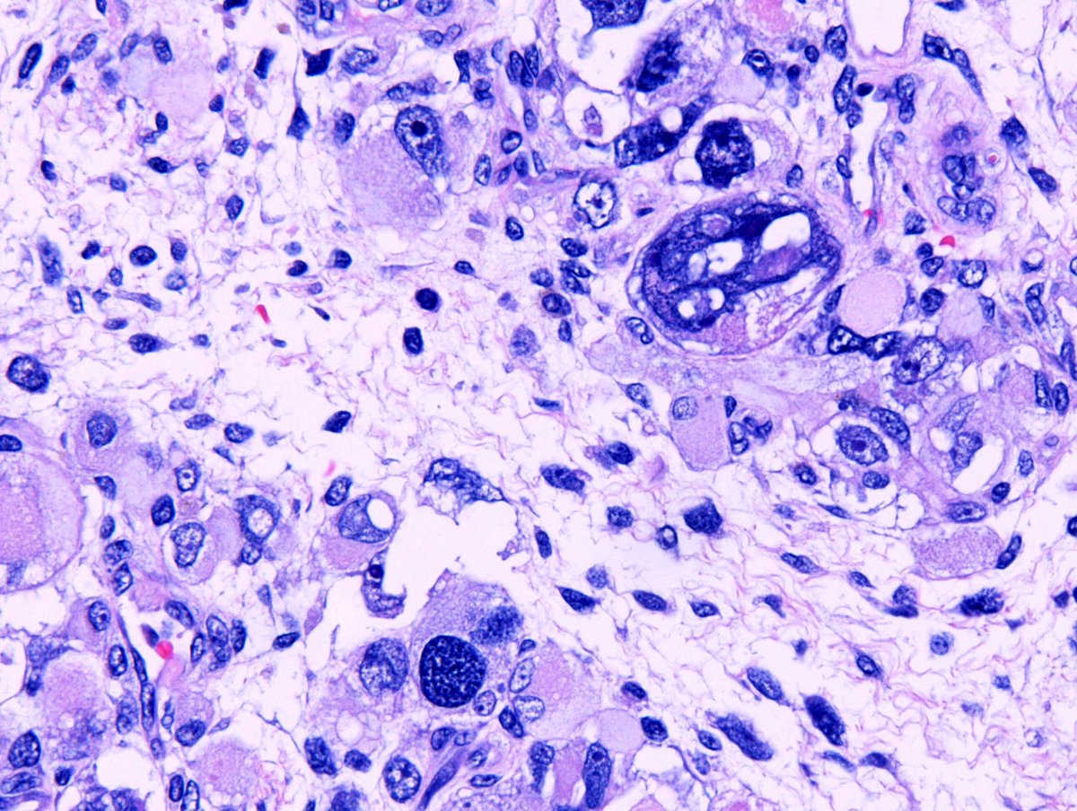 CuringN's tweet photo. Lung - What's your diagnosis?

Topic link: https://t.co/Q31AfBCfUZ

Images contributed by Aliya N. Husain, M.D.

Visit our CCN blog for cancer-related essays by Dr. Pernick: https://t.co/aaLBk9B2jb.

#Cancer #CancerResearch #CuringCancerNetwork #Pathology https://t.co/dUaR18f8RI